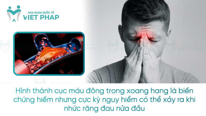 Nhuc rang dau nua dau phai lam sao 3 Hình thành cục máu đông trong xoang hang là biến chứng hiếm nhưng cực kỳ nguy hiểm có thể xảy ra khi nhức răng đau nửa đầu
