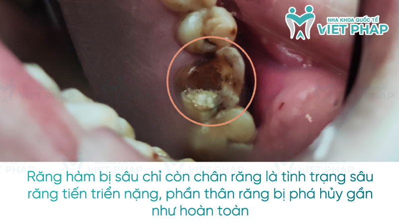 Rang ham bi sau chi con chan rang 1 Răng hàm bị sâu chỉ còn chân răng là tình trạng sâu răng tiến triển nặng, phần thân răng bị phá hủy gần như hoàn toàn