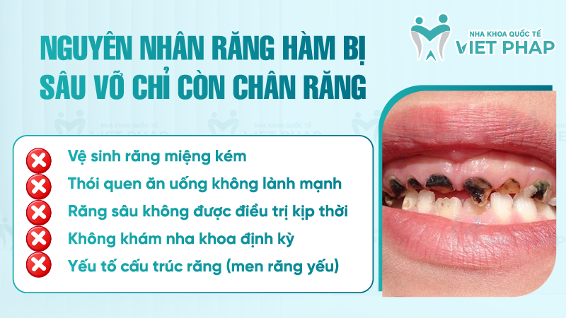 Rang ham bi sau chi con chan rang 2 Nguyên nhân răng hàm bị sâu vỡ chỉ còn chân răng