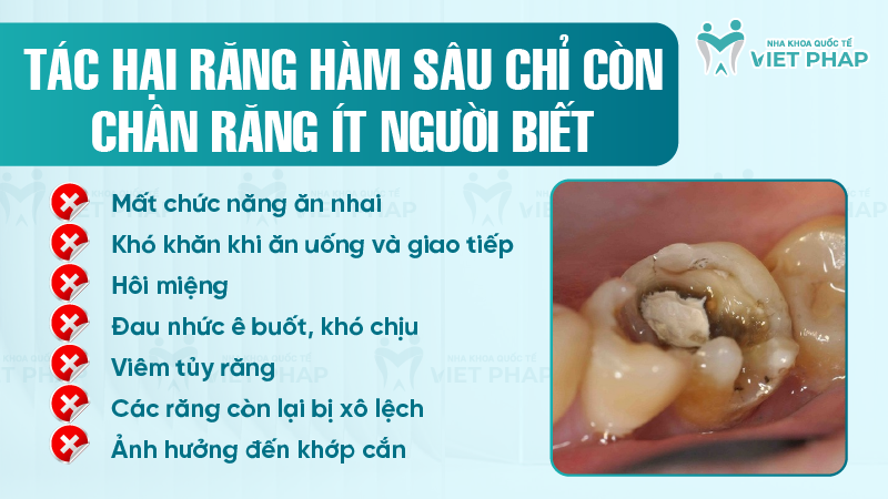 Rang ham bi sau chi con chan rang 3 Tác hại răng hàm sâu chỉ còn chân răng ít người biết