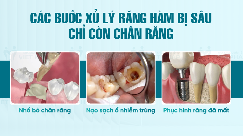 Rang ham bi sau chi con chan rang 4 Các bước xử lý răng hàm bị sâu chỉ còn chân răng