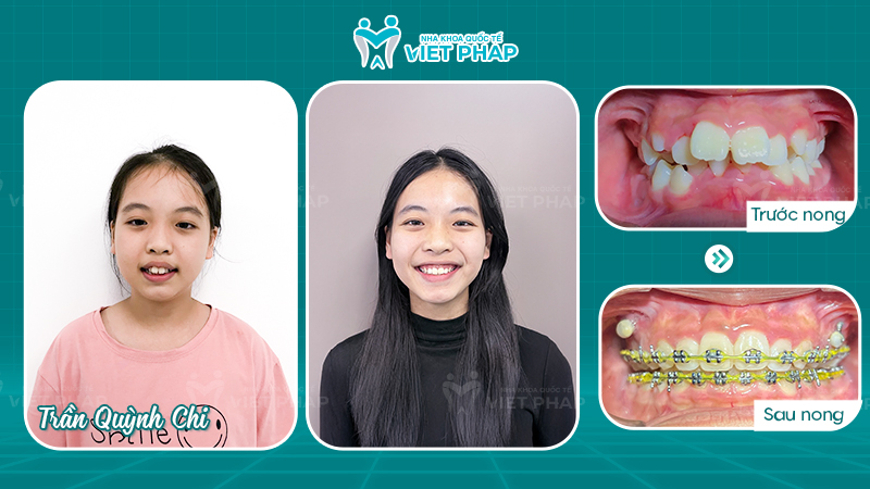 Ảnh Khách hàng Quỳnh Chi trước và sau nong hàm