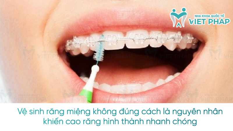 bao lau lay cao rang mot lan nha khoa quoc te viet phap 2 Vệ sinh răng miệng không đúng cách là nguyên nhân khiến cao răng hình thành nhanh chóng