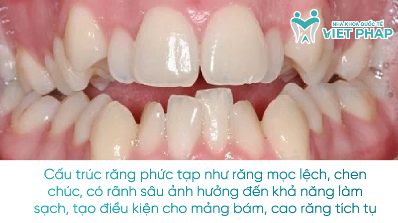 bao lau lay cao rang mot lan nha khoa quoc te viet phap 3 Cấu trúc răng phức tạp như răng mọc lệch, chen chúc, có rãnh sâu ảnh hưởng đến khả năng làm sạch, tạo điều kiện cho mảng bám, cao răng tích tụ