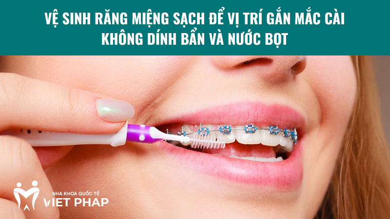 cach gan mac cai nieng rang 2.1 Vệ sinh răng miệng sạch để vị trí gắn mắc cài không dính bẩn và nước bọt