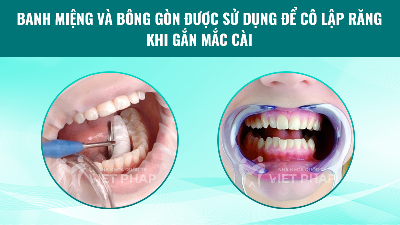 cach gan mac cai nieng rang 2.3 Banh miệng và bông gòn được sử dụng để cô lập răng khi gắn mắc cài