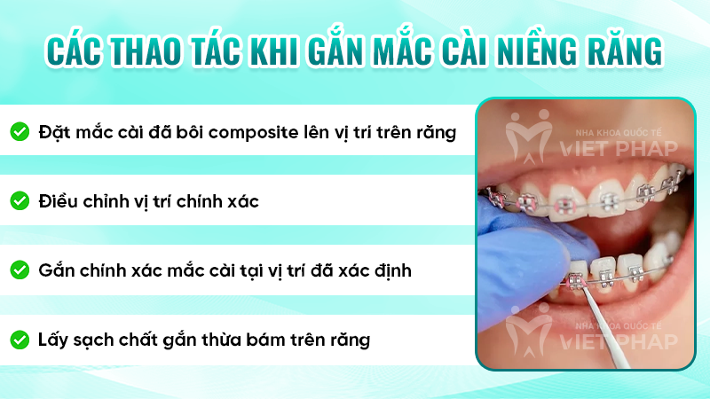 cach gan mac cai nieng rang 2.5 Các thao tác khi gắn mắc cài niềng răng