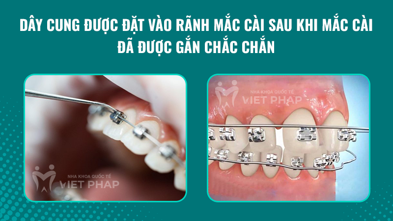 cach gan mac cai nieng rang 2.7 Dây cung được đặt vào rãnh mắc cài sau khi mắc cài đã được gắn chắc chắn