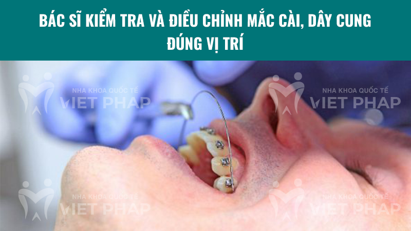 cach gan mac cai nieng rang 2.9 Bác sĩ kiểm tra và điều chỉnh mắc cài, dây cung đúng vị trí