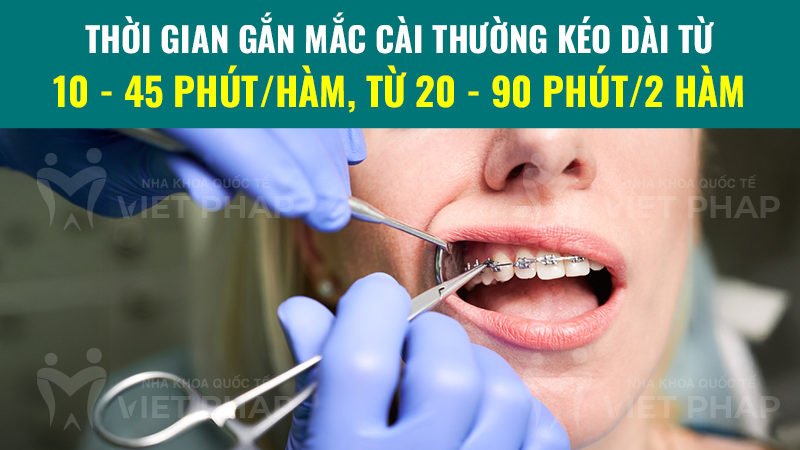 cach gan mac cai nieng rang 4 Thời gian gắn mắc cài thường kéo dài từ 10 - 45 phút/hàm, từ 20 - 90 phút/2 hàm