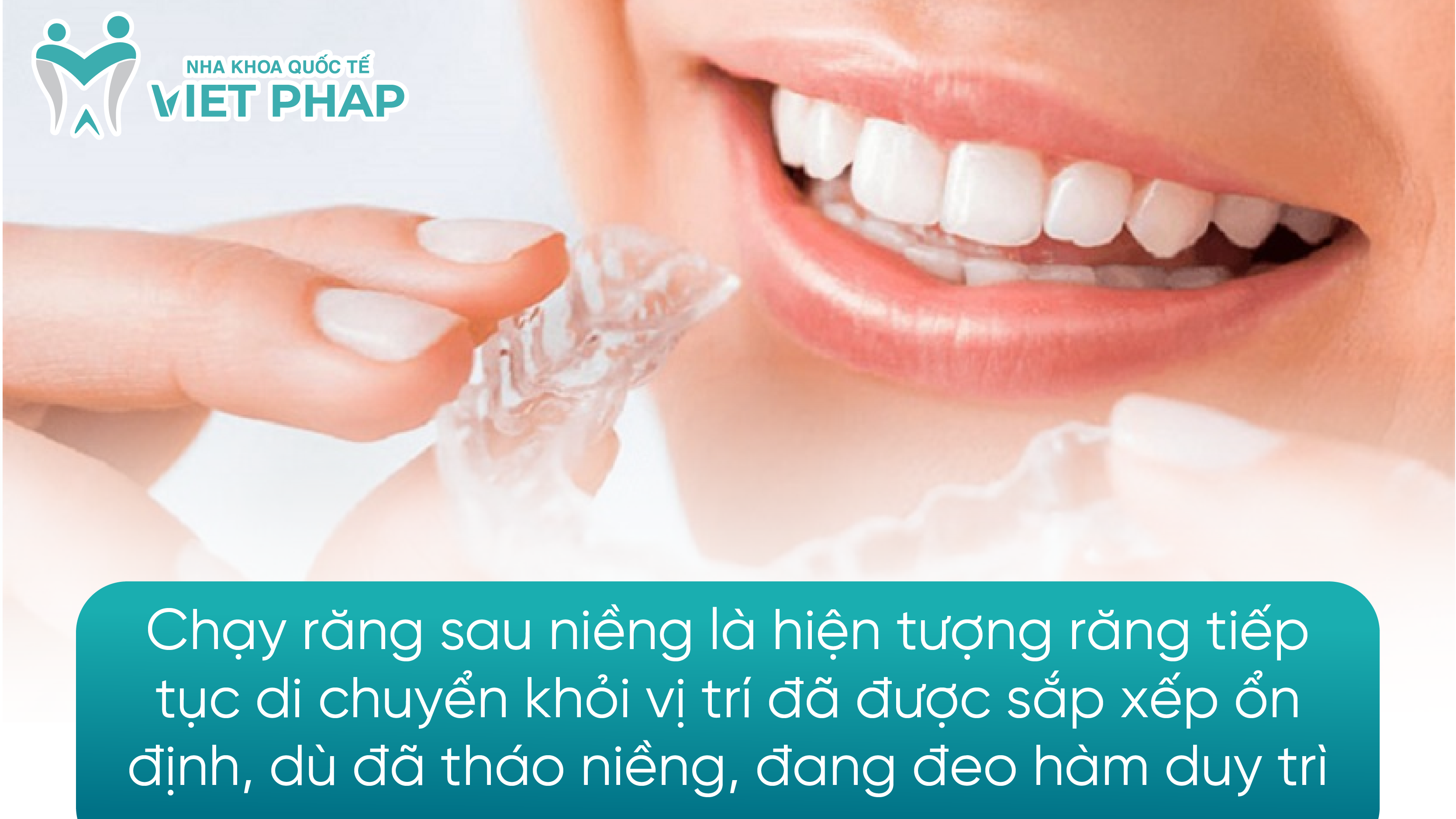 Chạy răng sau niềng là hiện tượng răng tiếp tục di chuyển khỏi vị trí đã được sắp xếp ổn định, dù đã tháo niềng, đang đeo hàm duy trì