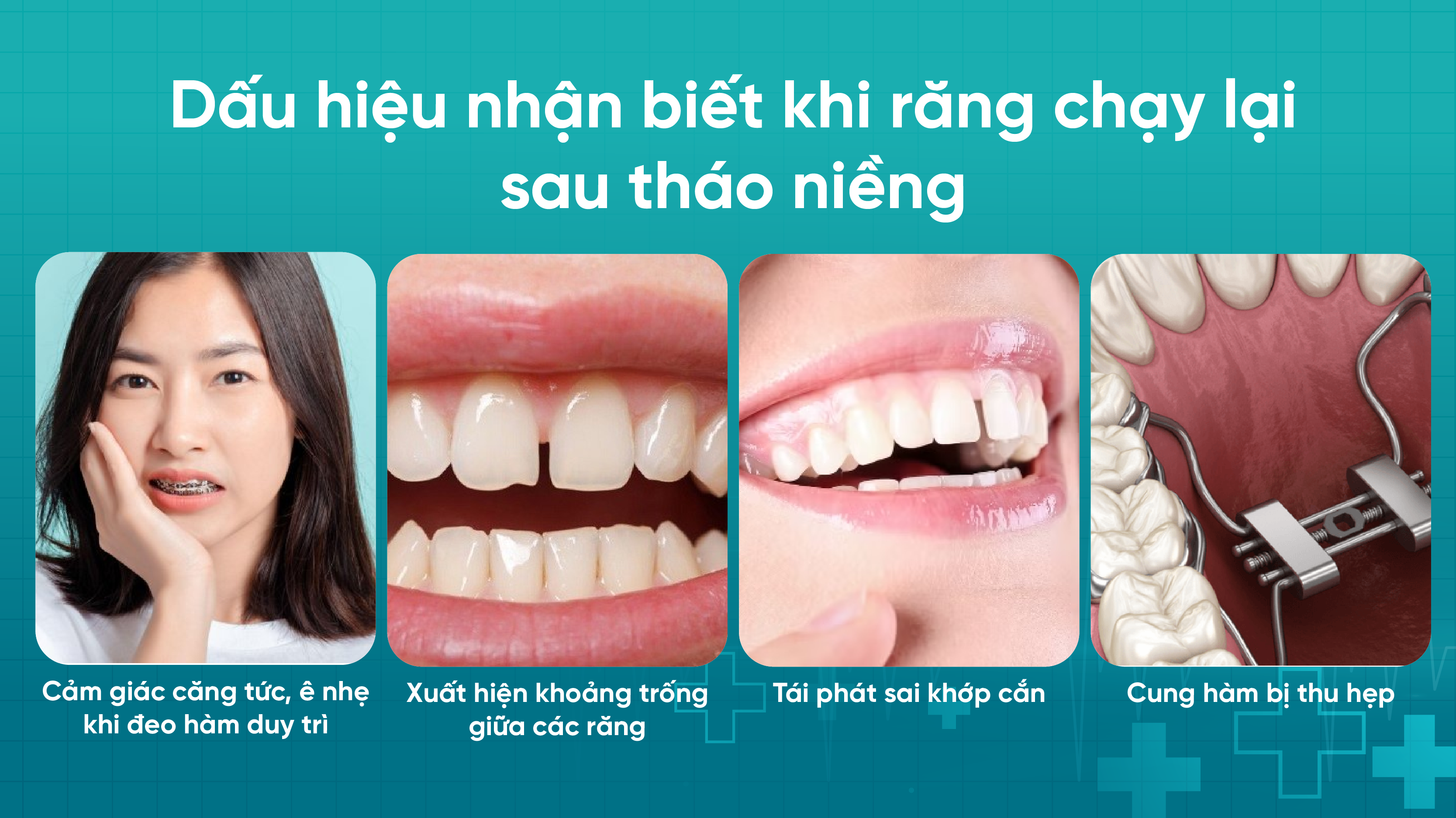 Dấu hiệu nhận biết khi răng chạy lại sau tháo niềng