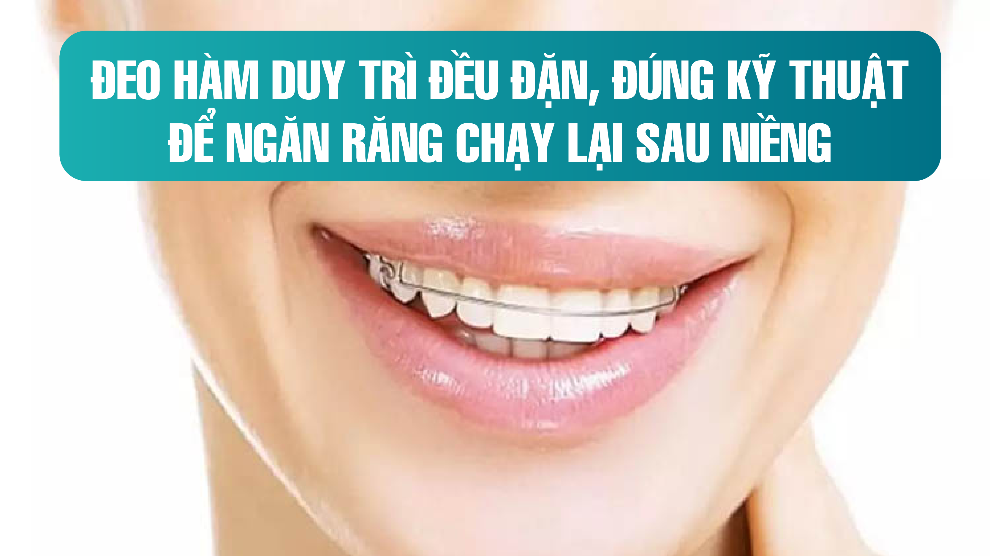Đeo hàm duy trì đều đặn, đúng kỹ thuật để ngăn răng chạy lại sau niềng