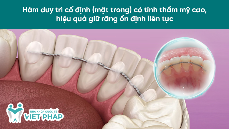 Hàm duy trì cố định (mặt trong) có tính thẩm mỹ cao, hiệu quả giữ răng ổn định liên tục