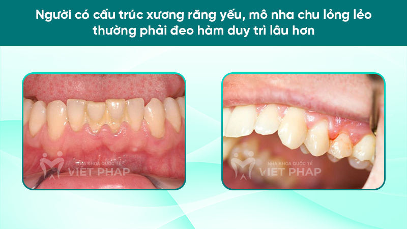 Người có cấu trúc xương răng yếu, mô nha chu lỏng lẻo thường phải đeo hàm duy trì lâu hơn