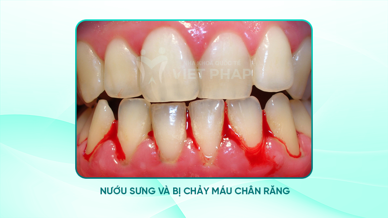 Hình ảnh nướu sưng và bị chảy máu chân răng 
