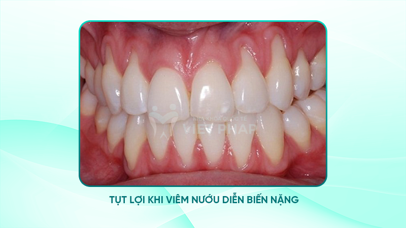 Răng bị tụt lợi khi viêm nướu diễn biến nặng