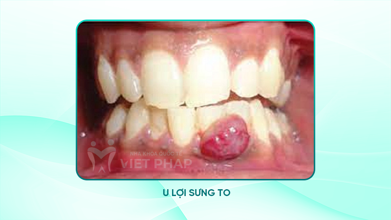 Hình ảnh u lợi sưng to