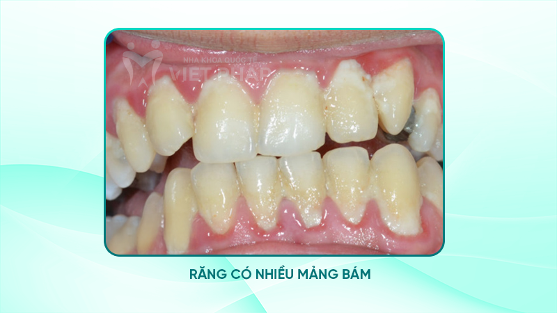 Hình ảnh thường răng có nhiều mảng bám