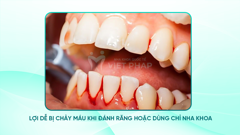 Hình ảnh viêm lợi chảy máu 