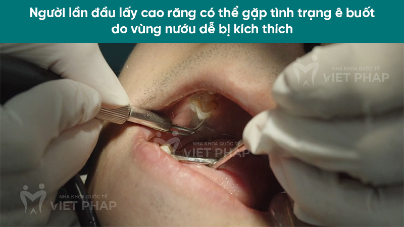 lay cao rang xong bi e buot 2.6 Người lần đầu lấy cao răng có thể gặp tình trạng ê buốt do vùng nướu dễ bị kích thích