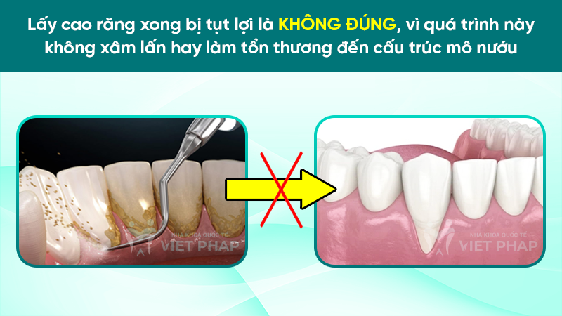 lay cao rang xong bi tut loi 1 Lấy cao răng xong bị tụt lợi là không đúng, vì quá trình này không xâm lấn hay làm tổn thương đến cấu trúc mô nướu