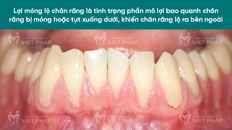 Lợi mỏng lộ chân răng là gì