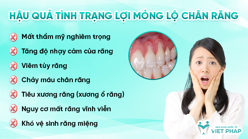 Hậu quả tình trạng lợi mỏng lộ chân răng
