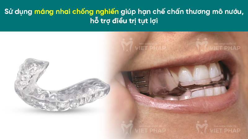 Sử dụng máng nhai chống nghiến giúp hạn chế chấn thương mô nướu, hỗ trợ điều trị tụt lợi 