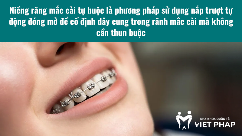 Niềng răng mắc cài tự buộc là phương pháp sử dụng nắp trượt tự động đóng mở để cố định dây cung trong rãnh mắc cài mà không cần thun buộc