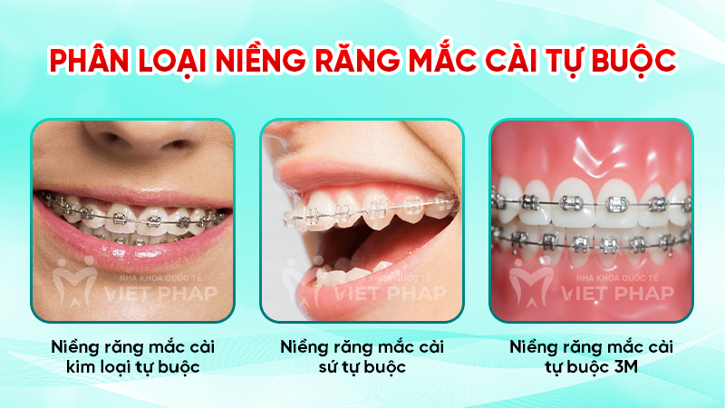 Phân loại niềng răng mắc cài tự buộc