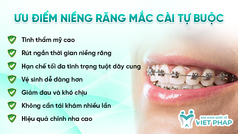 Ưu điểm niềng răng mắc cài tự buộc