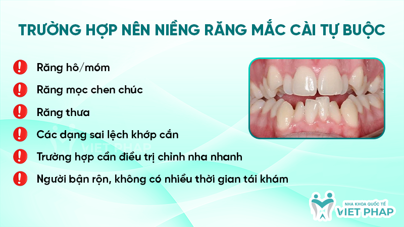 Trường hợp nên niềng răng mắc cài tự buộc 