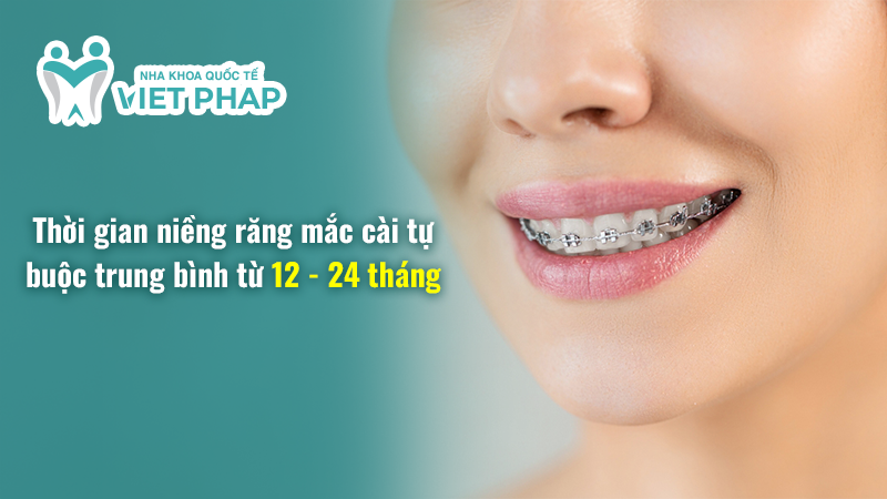 Thời gian niềng răng mắc cài tự buộc trung bình từ 12 - 24 thán