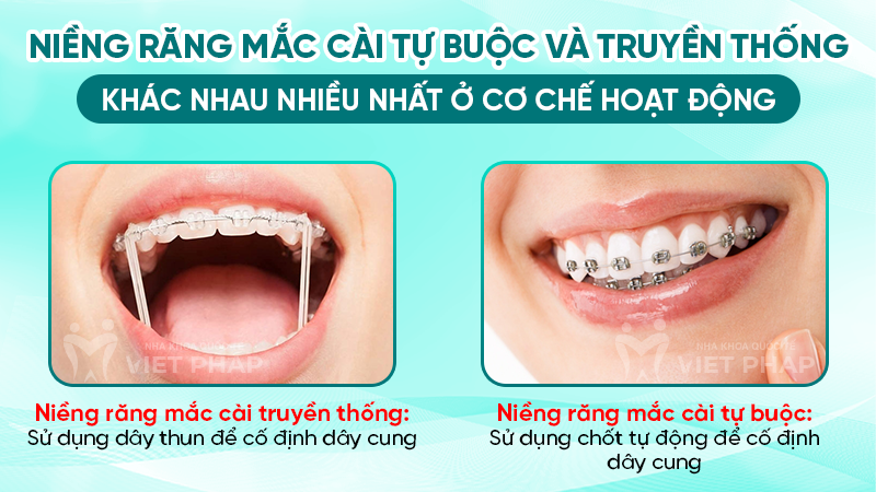 Niềng răng mắc cài tự buộc và truyền thống khác nhau nhiều nhất ở cơ chế hoạt động