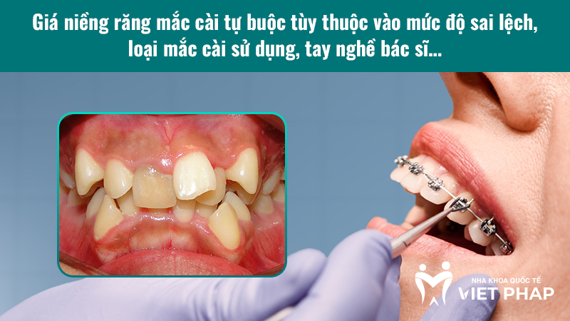 Giá niềng răng mắc cài tự buộc tùy thuộc vào mức độ sai lệch, loại mắc cài sử dụng, tay nghề bác sĩ…