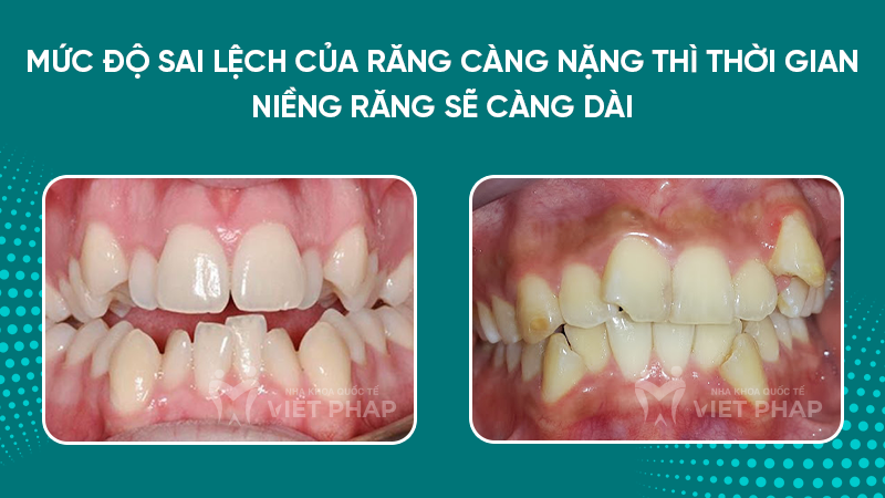 Mức độ sai lệch của răng càng nặng thì thời gian niềng răng sẽ càng dài