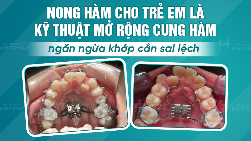 Nong hàm cho trẻ em là kỹ thuật mở rộng cung hàm ngăn ngừa khớp cắn sai lệch