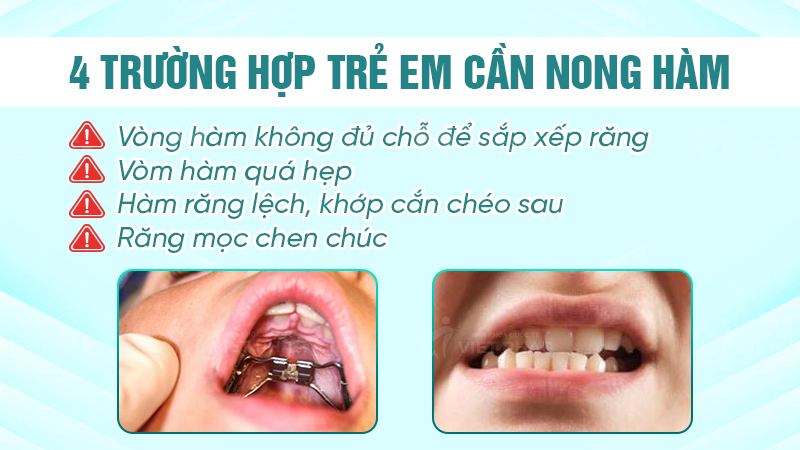 Trường hợp trẻ em cần nong hàm