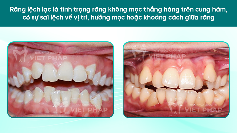 Răng lệch lạc là tình trạng răng không mọc thẳng hàng trên cung hàm, có sự sai lệch về vị trí, hướng mọc hoặc khoảng cách giữa răng