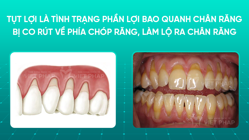 tut loi 1 Tụt lợi là tình trạng phần lợi bao quanh chân răng bị co rút về phía chóp răng, làm lộ ra chân răng
