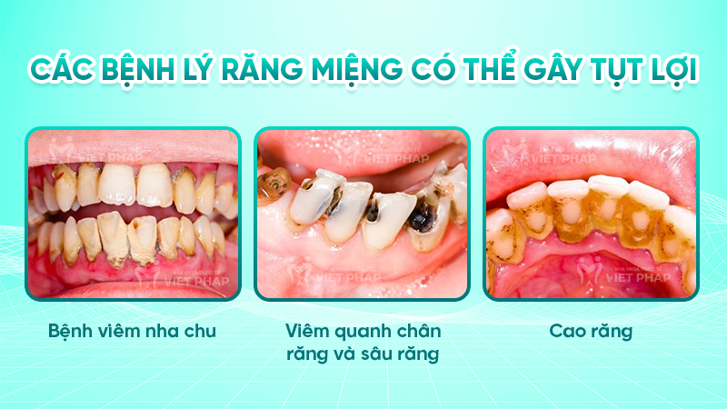 tut loi 3.2 Các bệnh lý răng miệng có thể gây tụt lợi