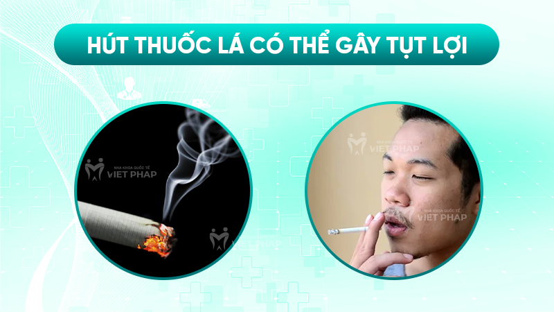 tut loi 3.5 Hút thuốc lá có thể gây tụt lợi
