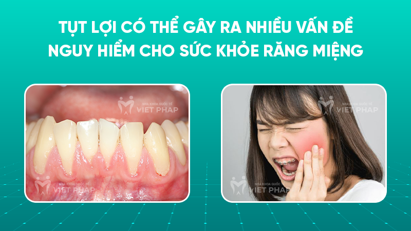 tut loi 8 Tụt lợi có thể gây ra nhiều vấn đề nguy hiểm cho sức khỏe răng miệng
