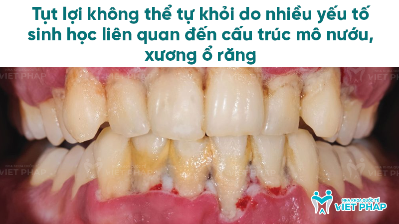 tut loi co the tu khoi khong nha khoa quoc te viet phap 2 Text: Tụt lợi không thể tự khỏi do nhiều yếu tố sinh học liên quan đến cấu trúc mô nướu, xương ổ răng
