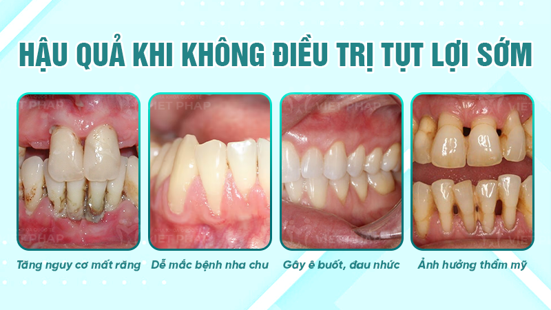 tut loi co the tu khoi khong nha khoa quoc te viet phap 6 Hậu quả khi không điều trị tụt lợi sớm