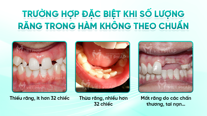 Trường hợp đặc biệt khi số lượng răng trong hàm không theo chuẩn