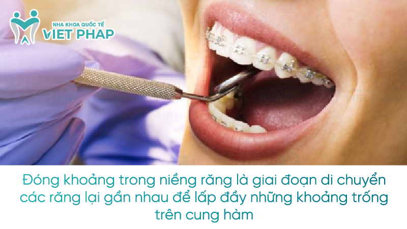 Đóng khoảng trong niềng răng là giai đoạn di chuyển các răng lại gần nhau để lấp đầy những khoảng trống trên cung hàm