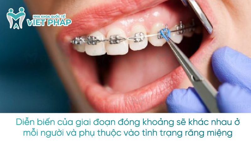 Diễn biến của giai đoạn đóng khoảng sẽ khác nhau ở mỗi người và phụ thuộc vào tình trạng răng miệng 