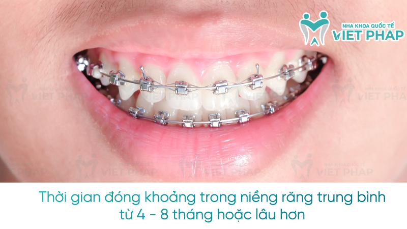 Thời gian đóng khoảng trong niềng răng trung bình từ 4 - 8 tháng hoặc lâu hơn